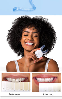  Advanced Teeth Bleaching System For YOU